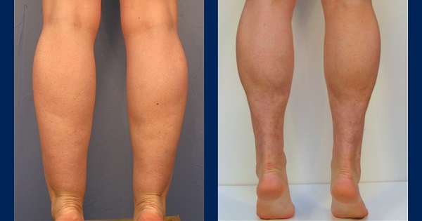 How to Get Rid of Cankles Fast → Get Skinny Ankles without surgery