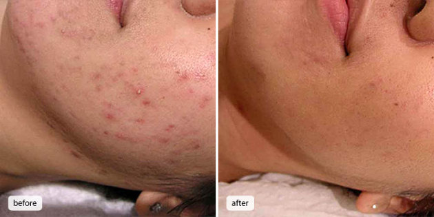 How To Get Rid Of Acne Fast → Naturally At Home Without Products.