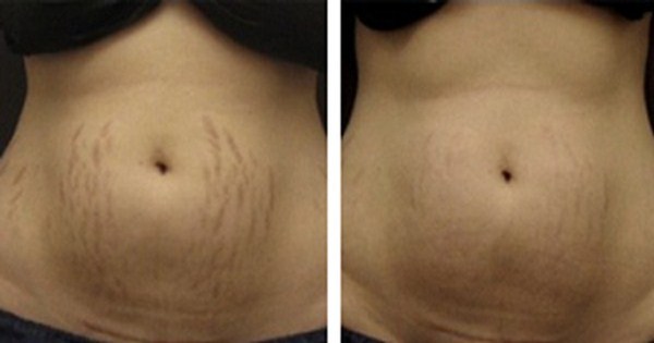 How to remove stretch marks fast- 5 easy remedies that actually work