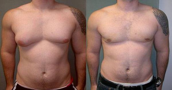 2 Ways to Get Rid of Man Boobs or Chest Fat Fast Without Surgery
